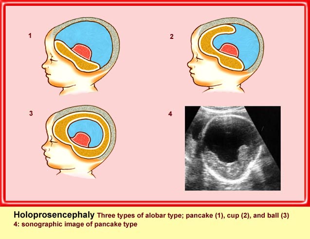 Holoprosencephaly Department Of Obstetrics And Gynecology Faculty Of 