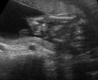 Limb Reduction Defects Department Of Obstetrics And Gynecology 