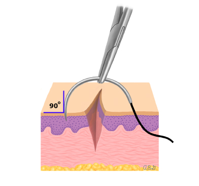 Suture1a