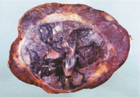 placenta08a