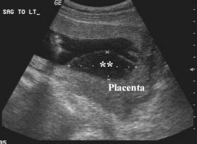 placenta15