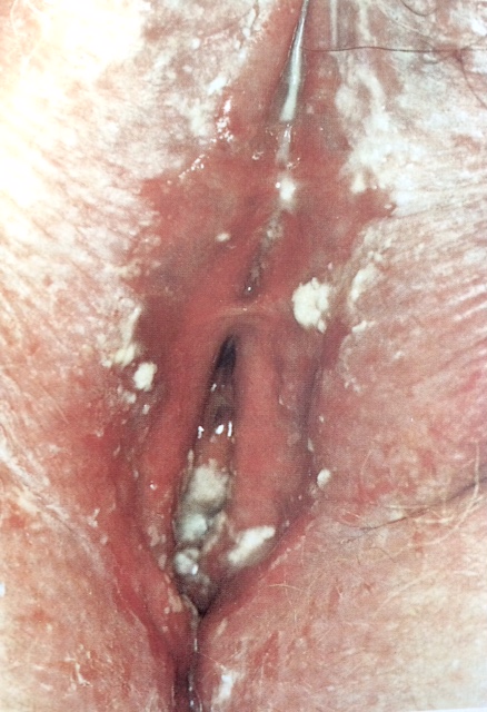Vulva14