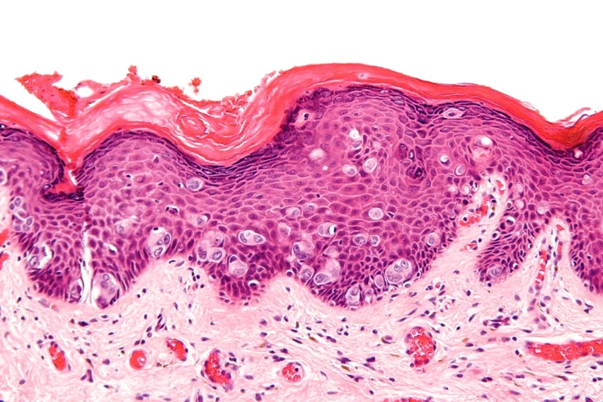 Labioscrotal swelling - Wikipedia