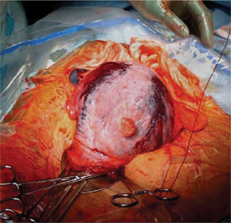 Placental Abruption - OBSTETRICAL COMPLICATIONS DUE TO PREGNANCY - Williams Manual of Pregnancy Complications, 23 ed.