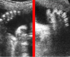 Excess Fingers Abnormal Hands and Feet - Department of Obstetrics and Gynecology ...
