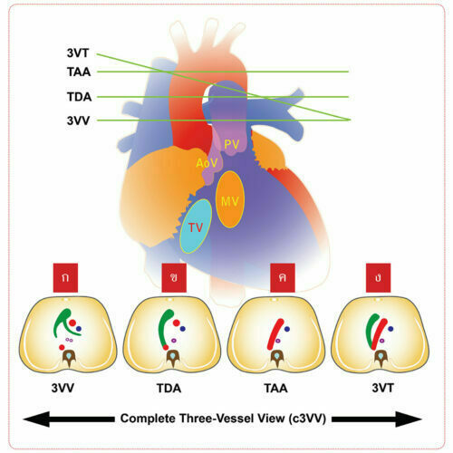 วิวเส้นเลือดใหญ่สามเส้น : Three-Vessel View - Department of Obstetrics ...