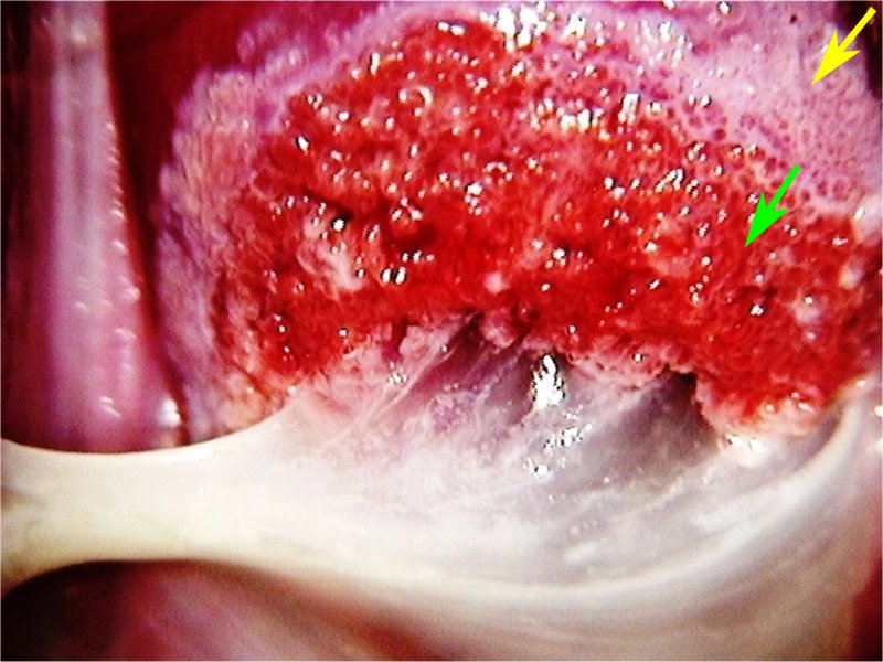 Close-up of a sore on the tongue Description automatically generated