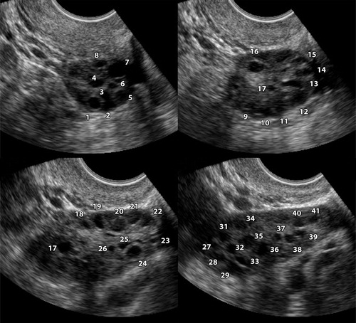 A collage of ultrasound images Description automatically generated