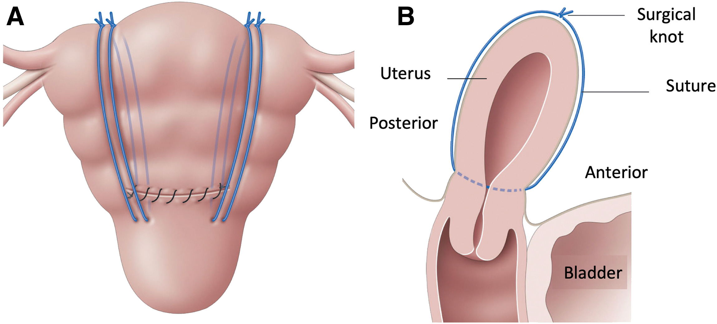 A diagram of the uterus Description automatically generated