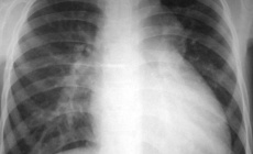 A child with dyspnea and mild cyanosis